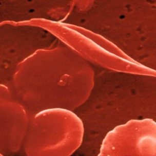 imagine cu anemii hemolitice